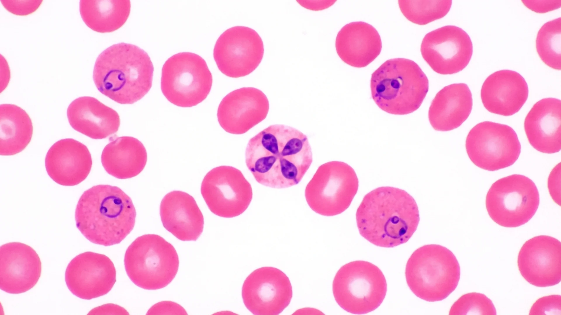 Babesia: The Parasitic Co-Infection